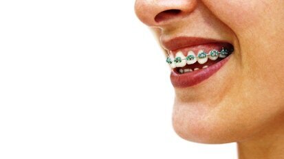 Kosmetyczna ortodoncja?