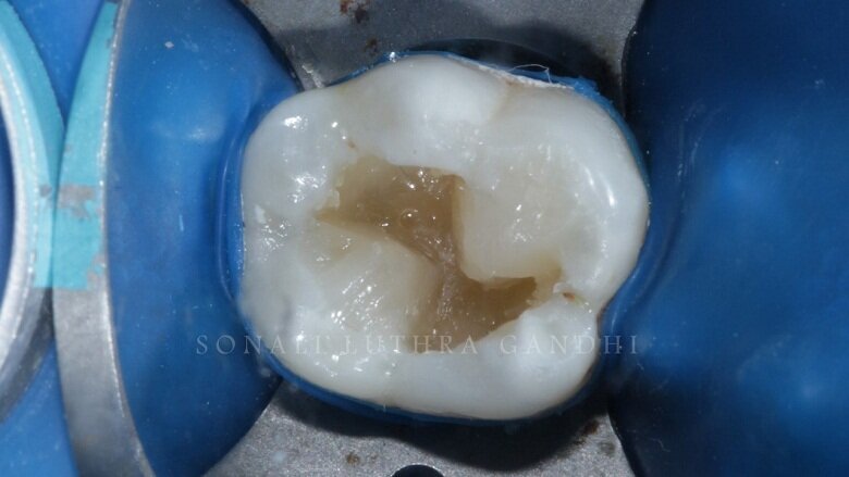 Fig 10: Disto-lingual Cusp