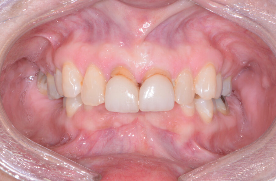 Fig. 2: Pre-op retracted biting view.