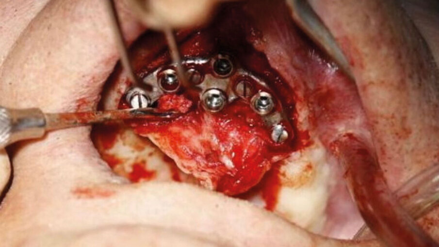 Fig. 5 - Foto durante l’inserimento del device.