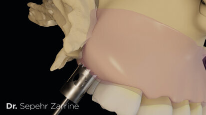 Carotte impactée transversalement.