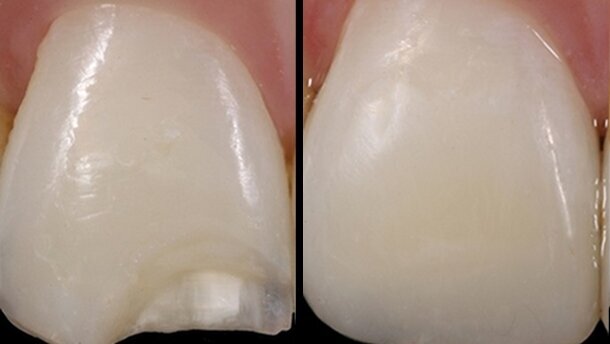 El experto en estética Luiz Rafael Calixto sobre la planificación de las restauraciones indirectas