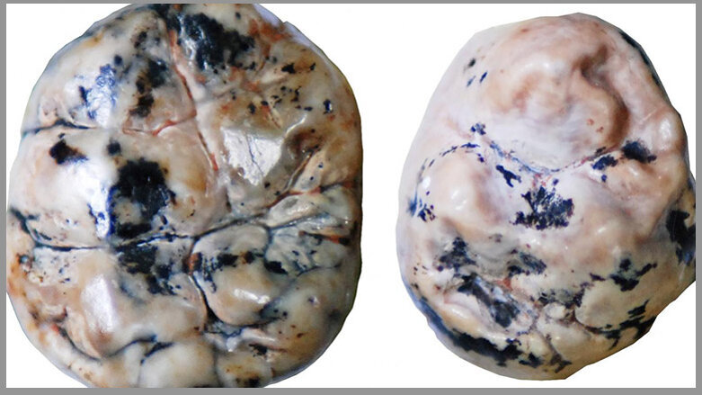 Analysis of ancient fossil teeth provides insight into breastfeeding habits