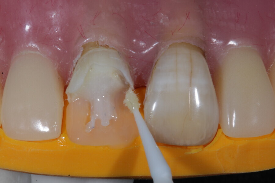 Fig. 14: The composite enamel layer (Estelite, Tokuyama Dental) is applied as a palatal shell.
