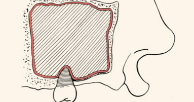 Colocación de una prótesis híbrida maxilar para  la rehabilitación fija del edéntulo con reabsorción severa
