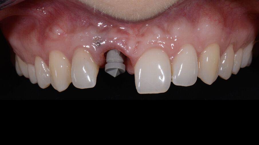 Fig. 30_Scan post e scan body posizionati sull’impianto.