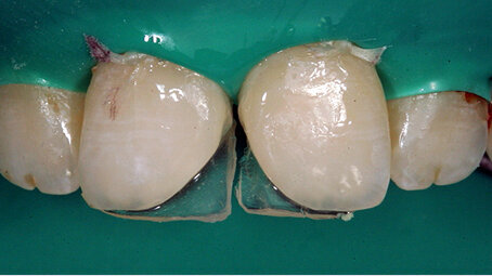Možnosti individuálního designu pro řezáky aneb každému, co jeho jest…