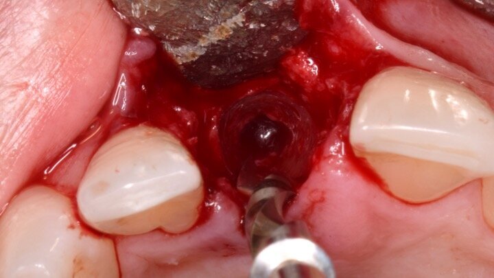 Figura 6. A pesar del defecto óseo, siempre buscamos la posibilidad de crear un nuevo alveolo quirúrgico que emerja por la zona del cíngulo de los dientes adyacentes, es decir, el margen de emergencia adecuado. En estos defectos, intentamos siempre el anclaje en profundidad con implantes largos de unos 16 mm debido al gran defecto existente. Es la única forma de que la estabilidad primaria del implante permita realizar una Prótesis Inmediata.