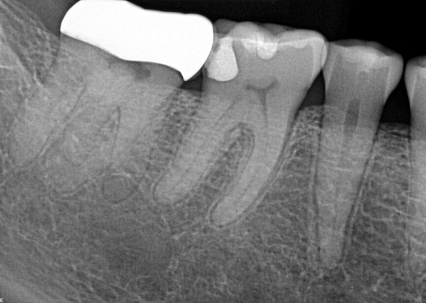 Fig. 20a: Note the attention to detail required to locate all of the canals in this exceptional case done under the surgical microscope. (Courtesy of Dr. Adrian Silberman)