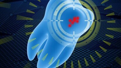 Късовълновите инфрачервени лъчи крият потенциал за откриване на вторични кариозни лезии