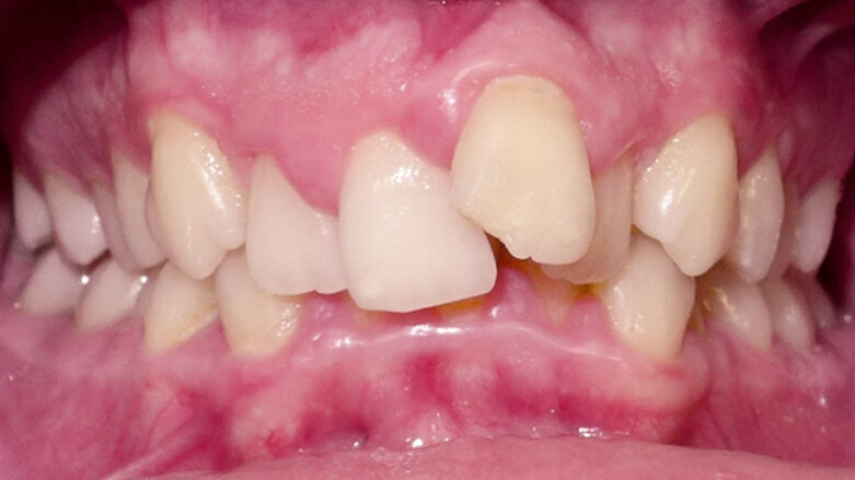 Neextrakční léčba závažného stěsnání pomocí cyklických sil a kortikotomií