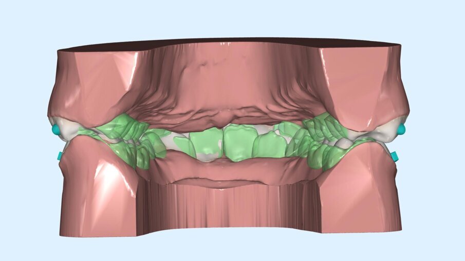 Fig. 5_Confronto prima e dopo della programmazione per controllo dei movimenti posteriori.