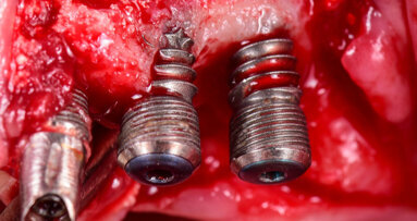 Systematic overview improves understanding of periimplantitis