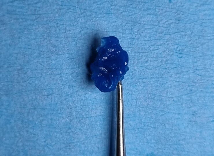 Fig. 3: The stamp shows a detailed imprint of the occlusal anatomy.