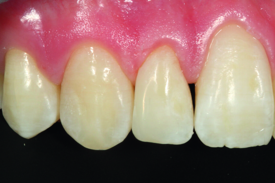 Afbeelding 13. Restauratie met OMNICHROMA: zeer goede kleuraanpassing van de randopbouw.