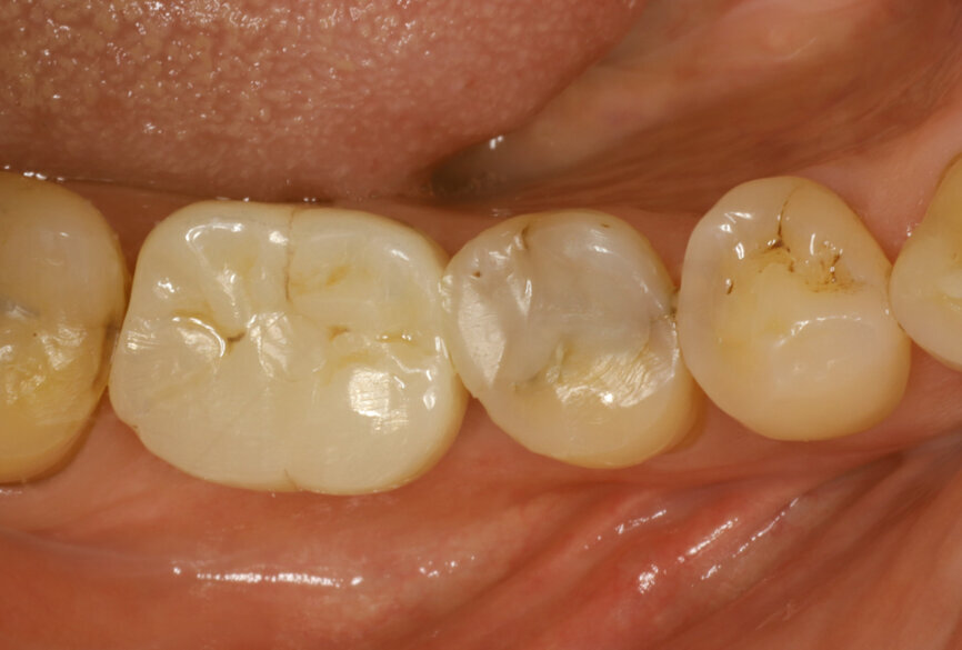 Fig. 28: Straumann TLX one-year follow-up clinical outcome.
