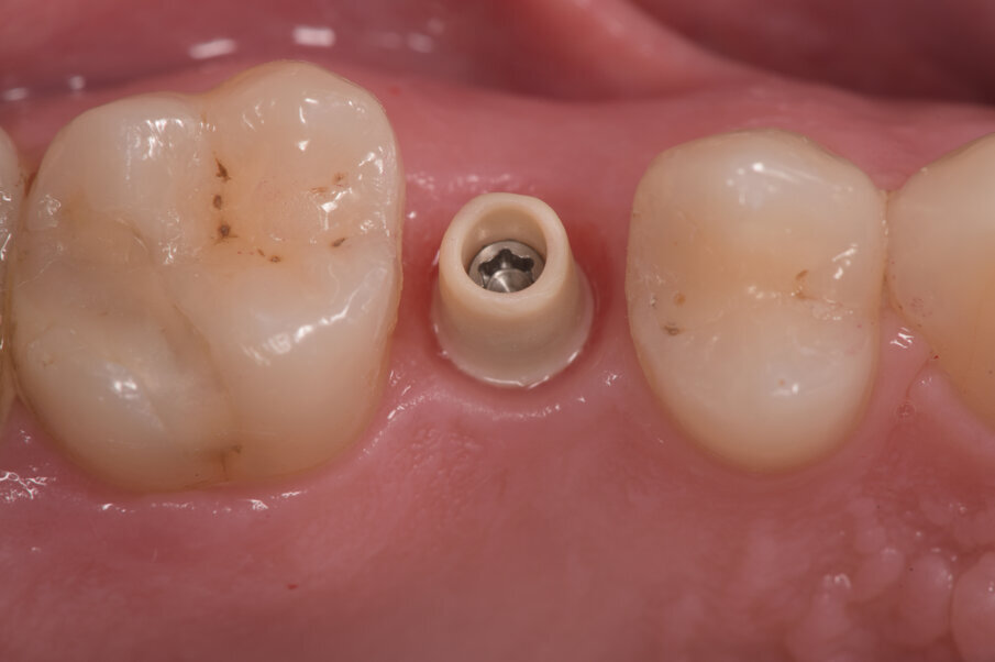 Fig. 10 - Il moncone definitivo è in PEKK (poli-etere-chetone-chetone), un polimero termoplastico altamente biocompatibile e resistente ai fluidi orali e alle forze masticatorie. Su questo moncone possiamo cementare la corona o incollarla per realizzare un avvitamento.