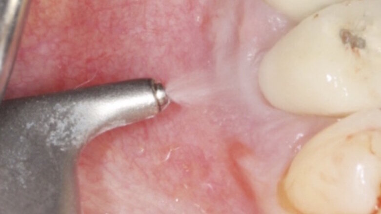 İmplant Sıkıntılarından İmplantın Nirvanasına