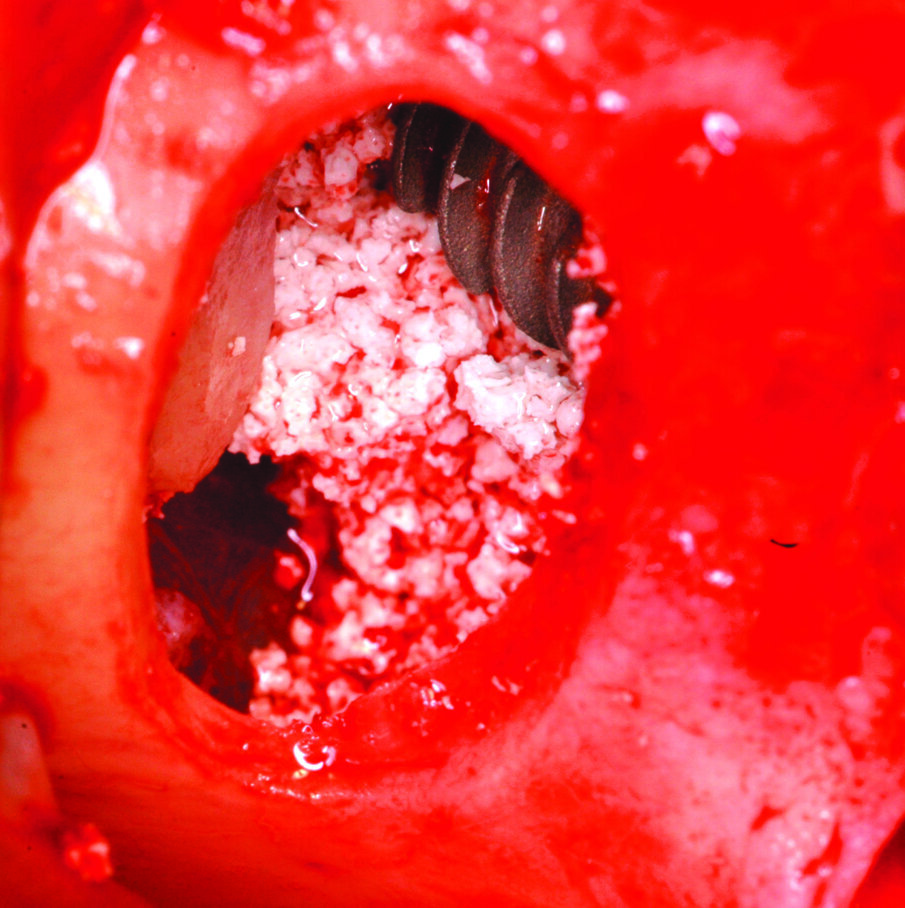 Fig. 10_Particolare dell’iniziale riempimento del seno mascellare e dell’inserimento implantare.