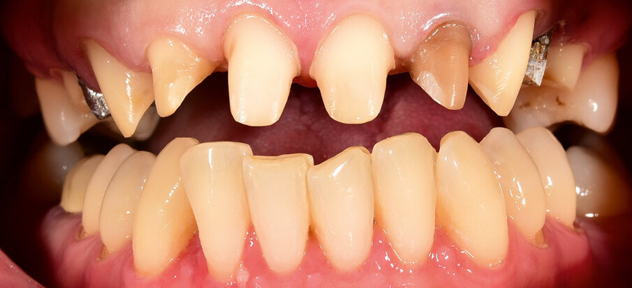 Fig. 3: Teeth 15 to 25 were prepared