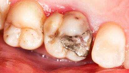 In odontoiatria niente diritto di ingresso per l’amalgama