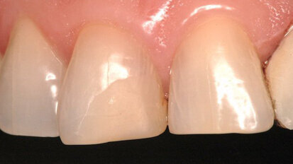 La fluorescencia en restauraciones de resina directa