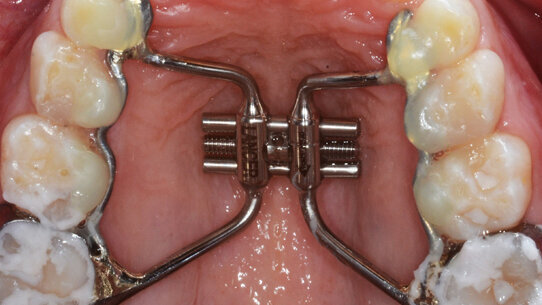 Effetto dell’Ibuprofene nella gestione del dolore  in pazienti sottoposti a espansione rapida del palato
