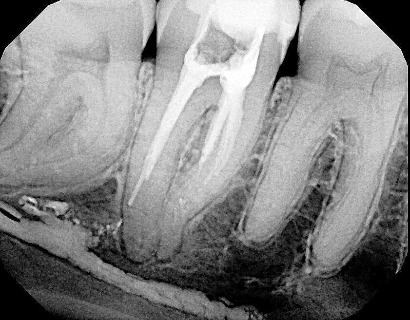Fig. 3: Calcium hydroxide extruded into the mandibular canal through a perforation.