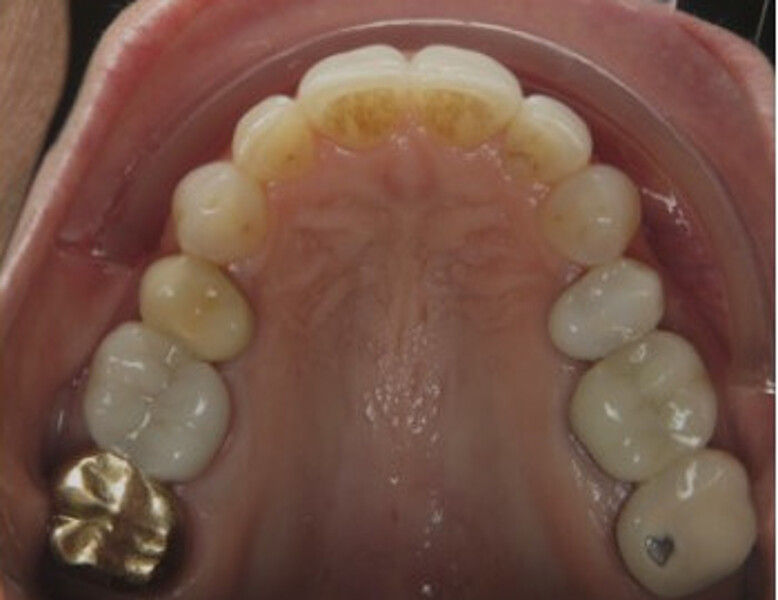 Figs. 6a–e: Progress treatment photographs after 12 steps of aligner treatment.