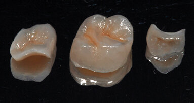 Restauri adesivi indiretti nei settori posteriori