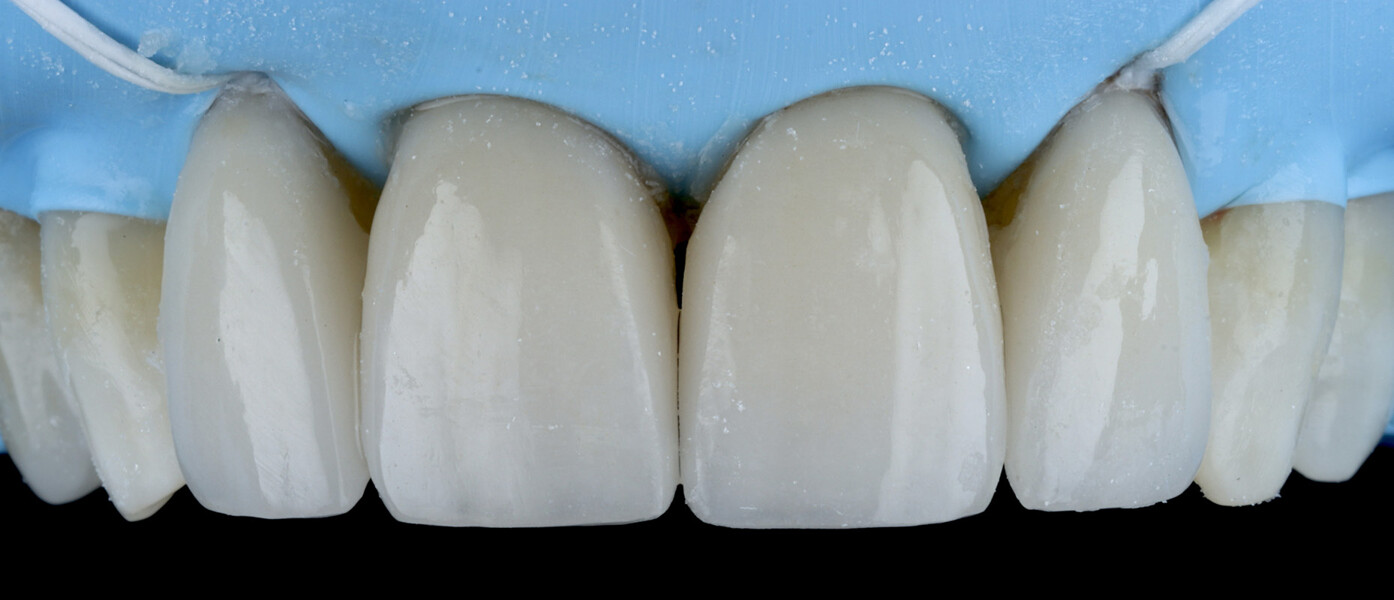 Fig. 21a: Lateral incisor veneers after placement and initial removal of excess cement. 