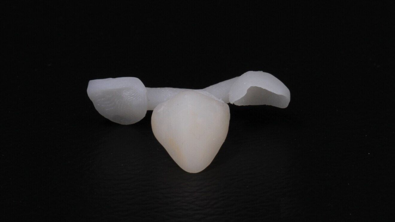 Fig. 9: 3D-printed characterised shell provisional restoration with a vertical stop to guide intra-oral chairside pick-up. 