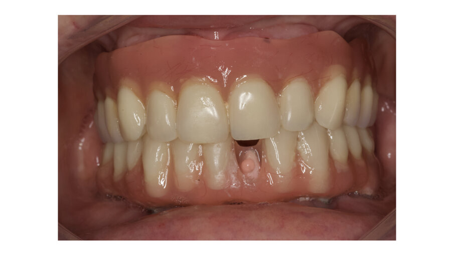 Fig. 12: Debonding of prefabricated tooth is very common on overdentures.