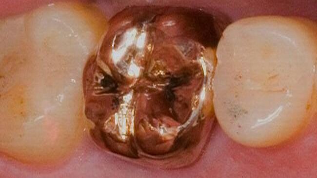 Vraag naar dentaal goud daalt sterk