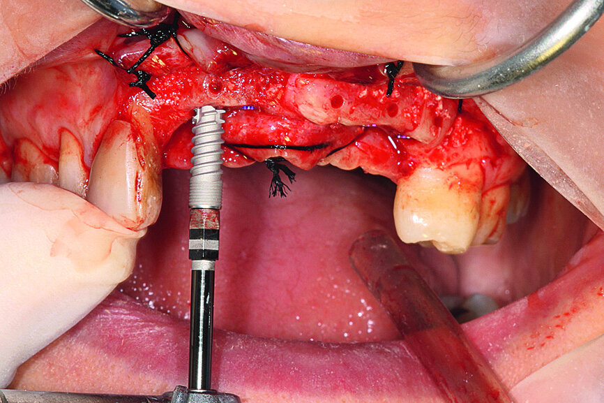 Fig. 15: Aadva self-tapping implants were placed.