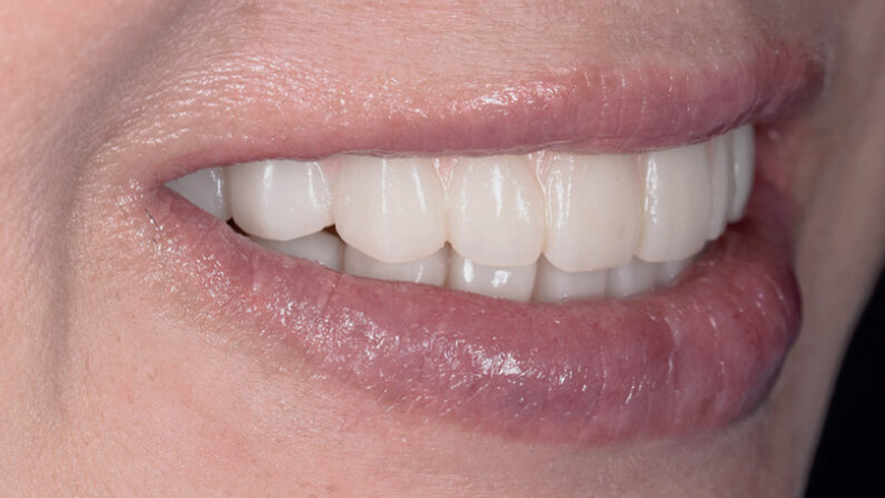 Customised aesthetics for provisional profile prosthesis with ceramage gum