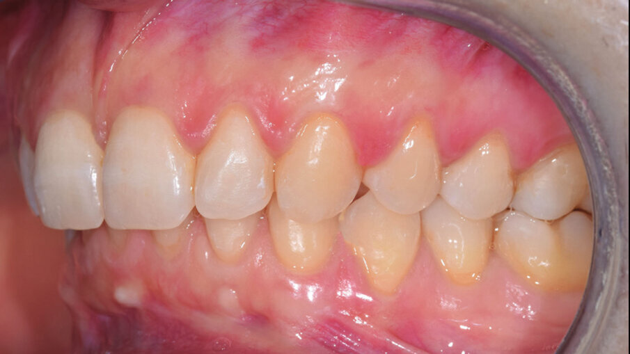 Figg. 8g, 8h_Foto occlusali di fine trattamento.