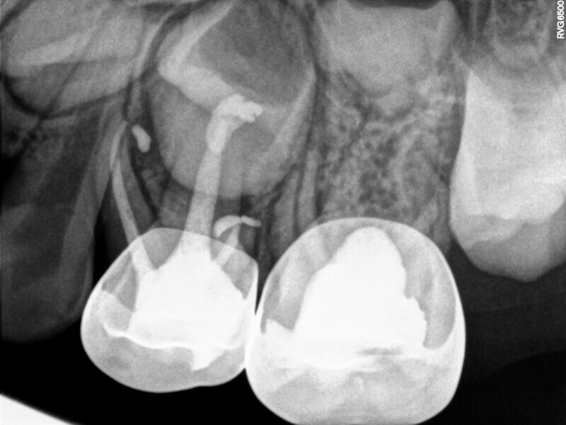 Fig. 21 : Obturation de trois canaux radiculaires et restauration définitive.