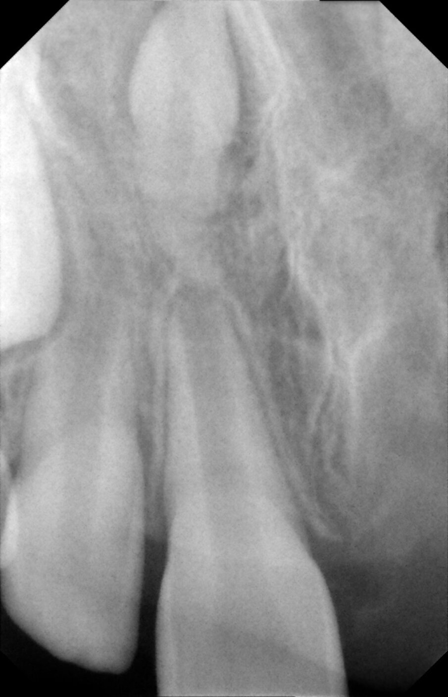 Figures 4a.  Empty socket of 21 due to its avulsion. Notice the immature apices of 12, 11 and 22. In addition there was a supernumerary tooth/mesiodens