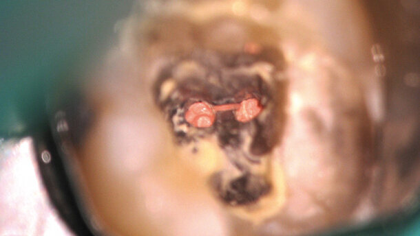 Le traitement d’une molaire mandibulaire calcifiée : un protocole des temps modernes