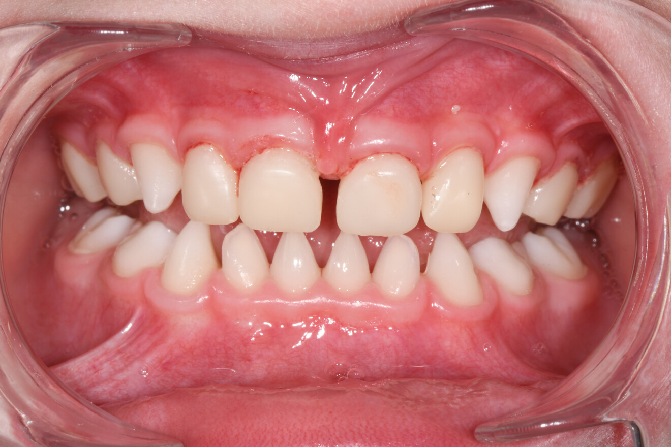 Figs. 8a–f: Cementation of the restorations in the mouth.