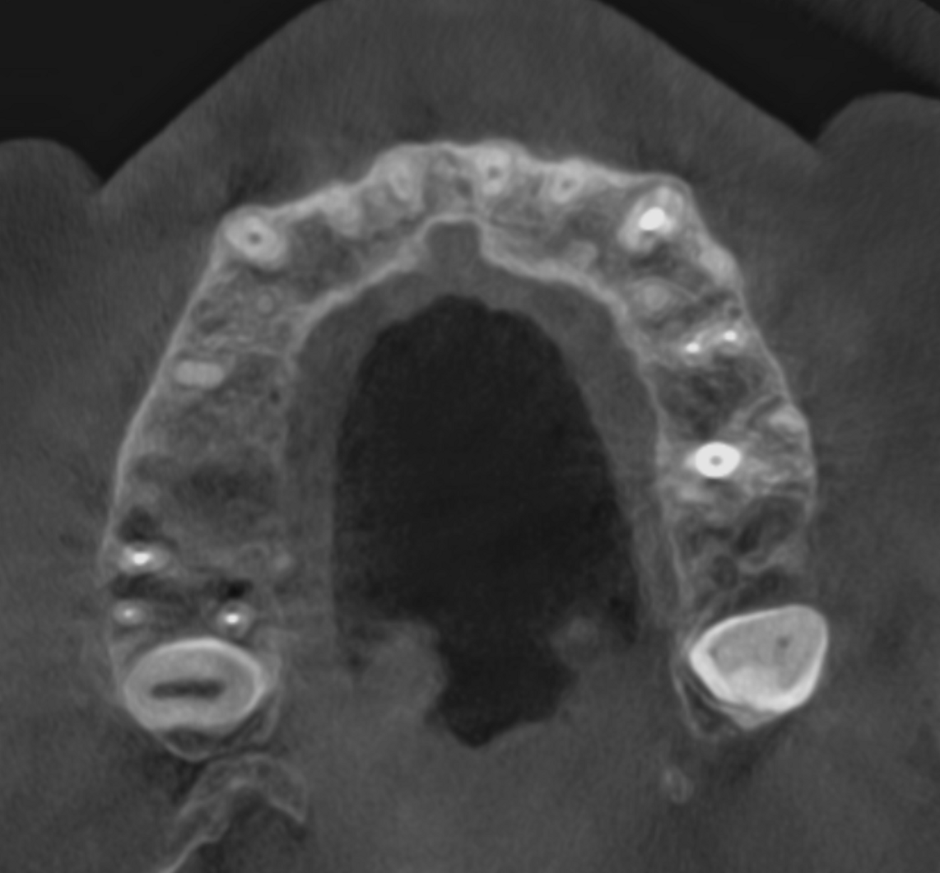 Fig. 9a: Large-volume CBCT scan. Transversal cross-section of the maxilla showing bone regeneration around the roots of tooth #17 and crestal wall healing.