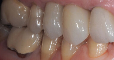 Ripristino Estetico-Funzionale di un canino fratturato