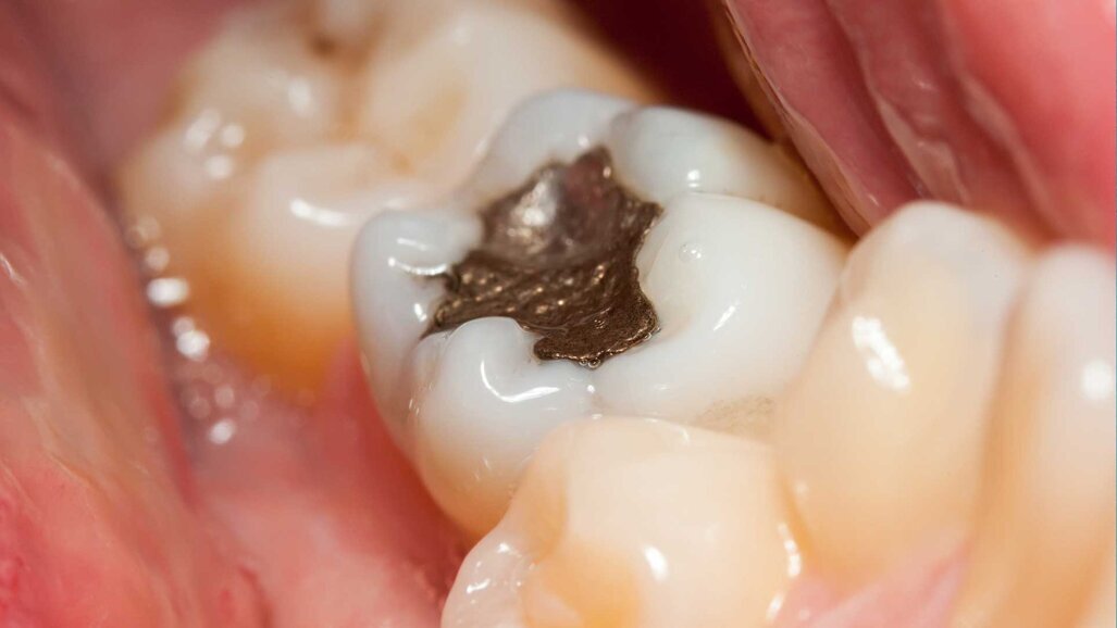 Schweiz unterstützt Einschränkung von Amalgam