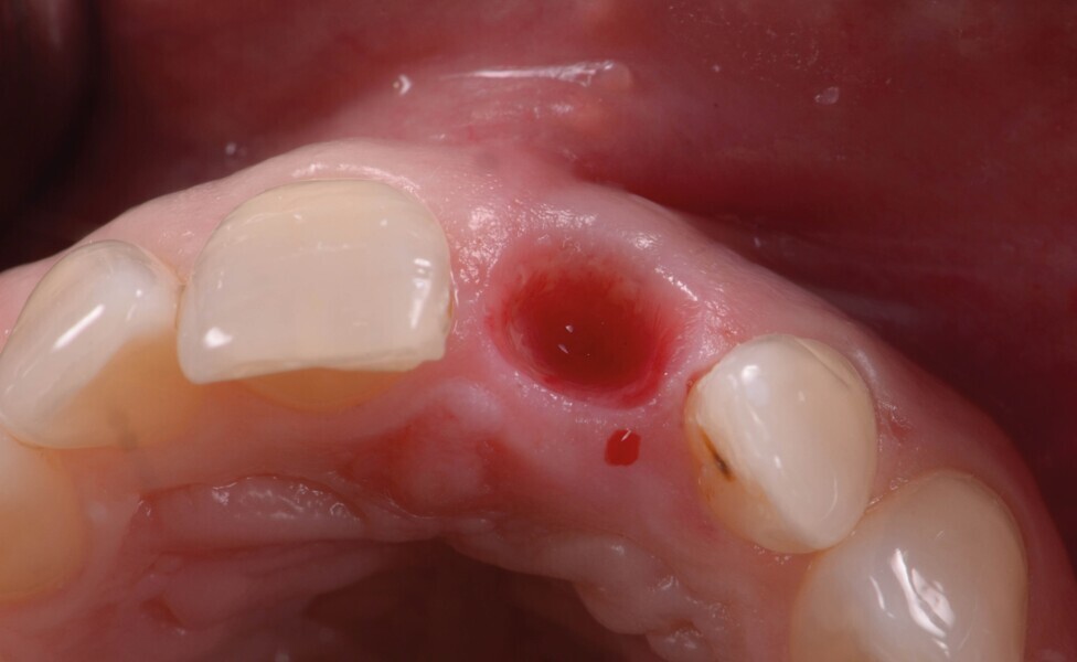 Fig. 9 b: Après une période de cicatrisation de quatre mois.