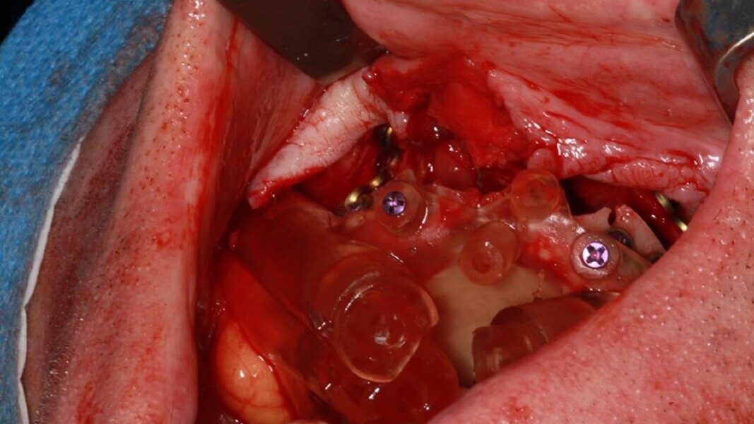 Fig. 6: Intra-operative view showing preparation of the zygomatic implant sites and pin hole placement.