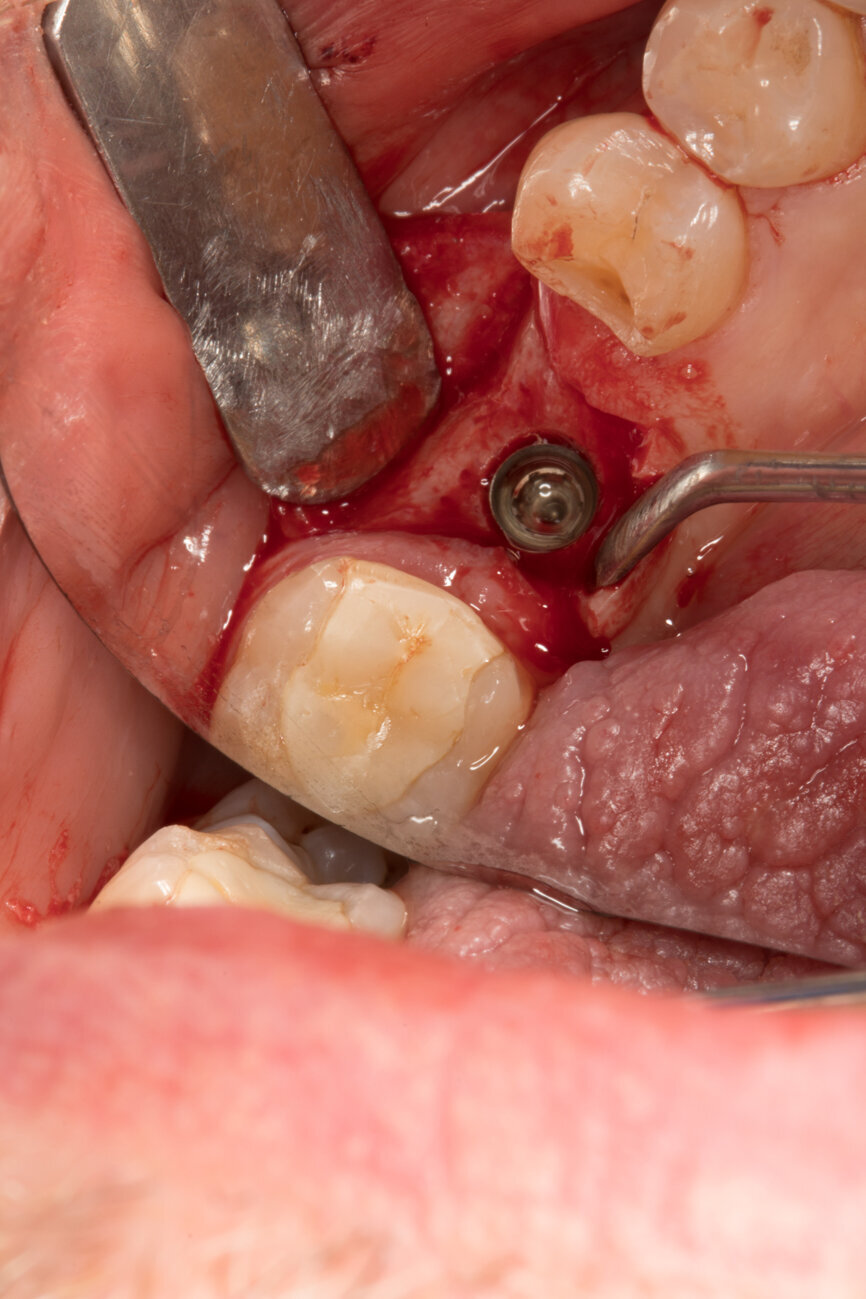 Ryc. 15_Widoczna platforma implantu umieszczonego w okolicy 46.