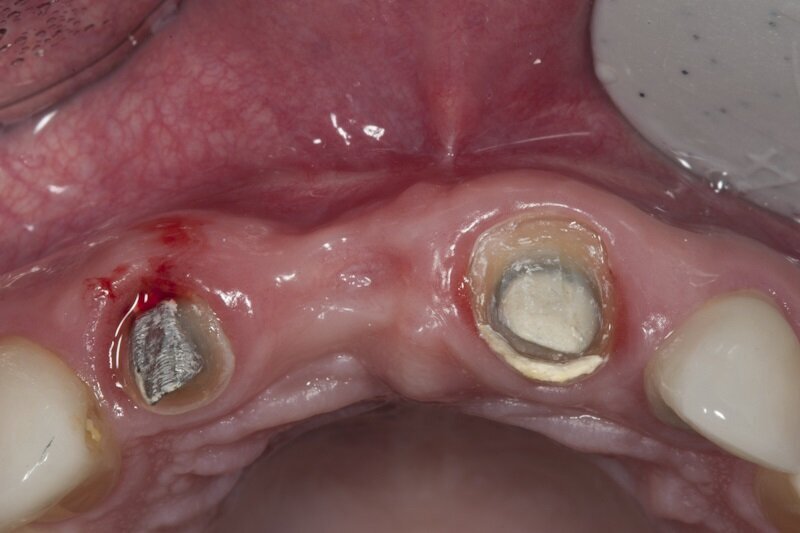 Ryc. 10_Zabieg regeneracji kostnej.