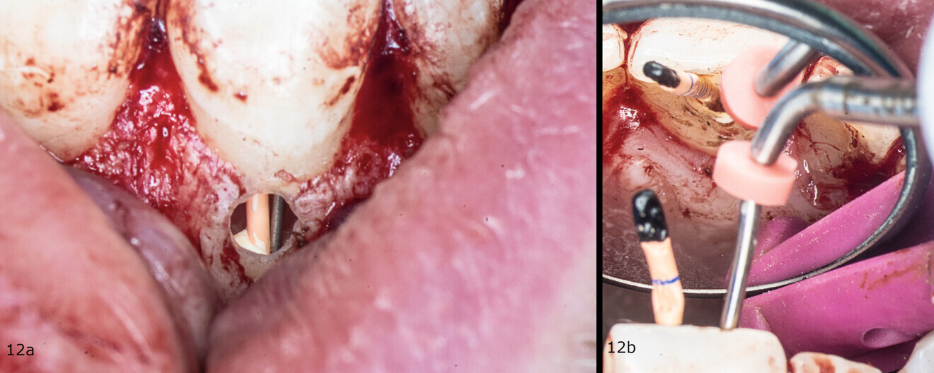 Figs. 12a & b: Obturation of the root canal.