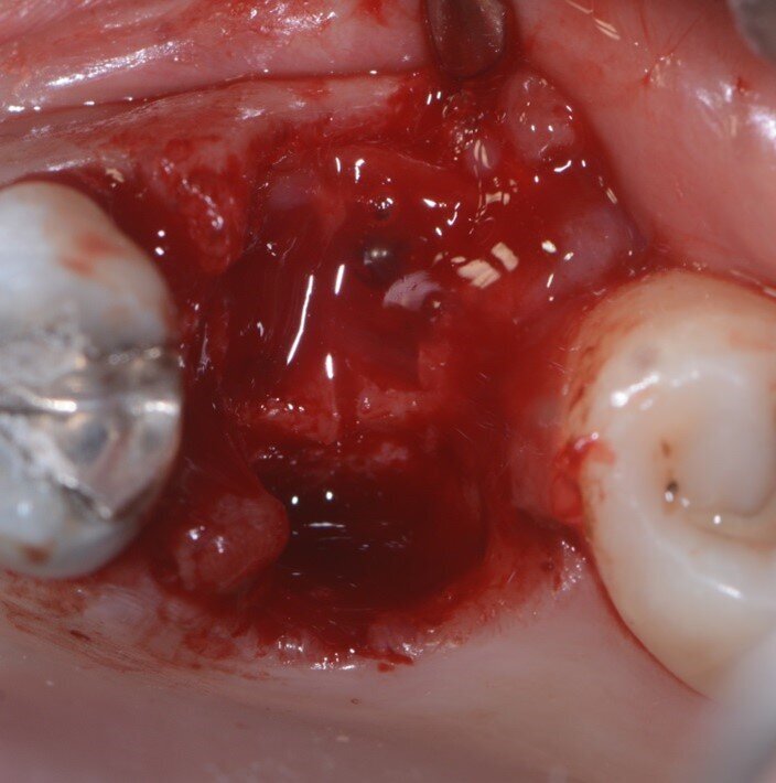 Fig. 5 - Lamina corticale soft incollata vestibolarmente.